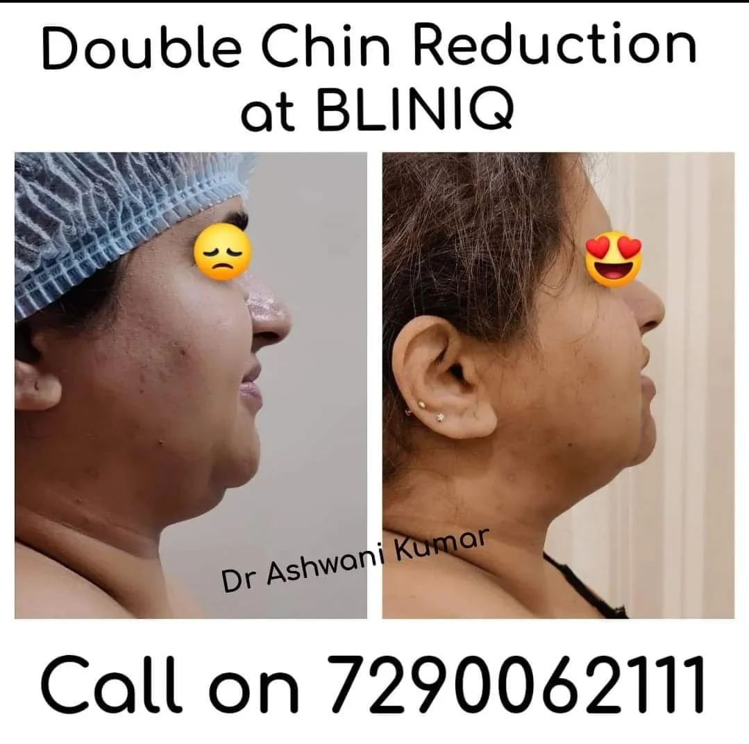 Chin Contouring After