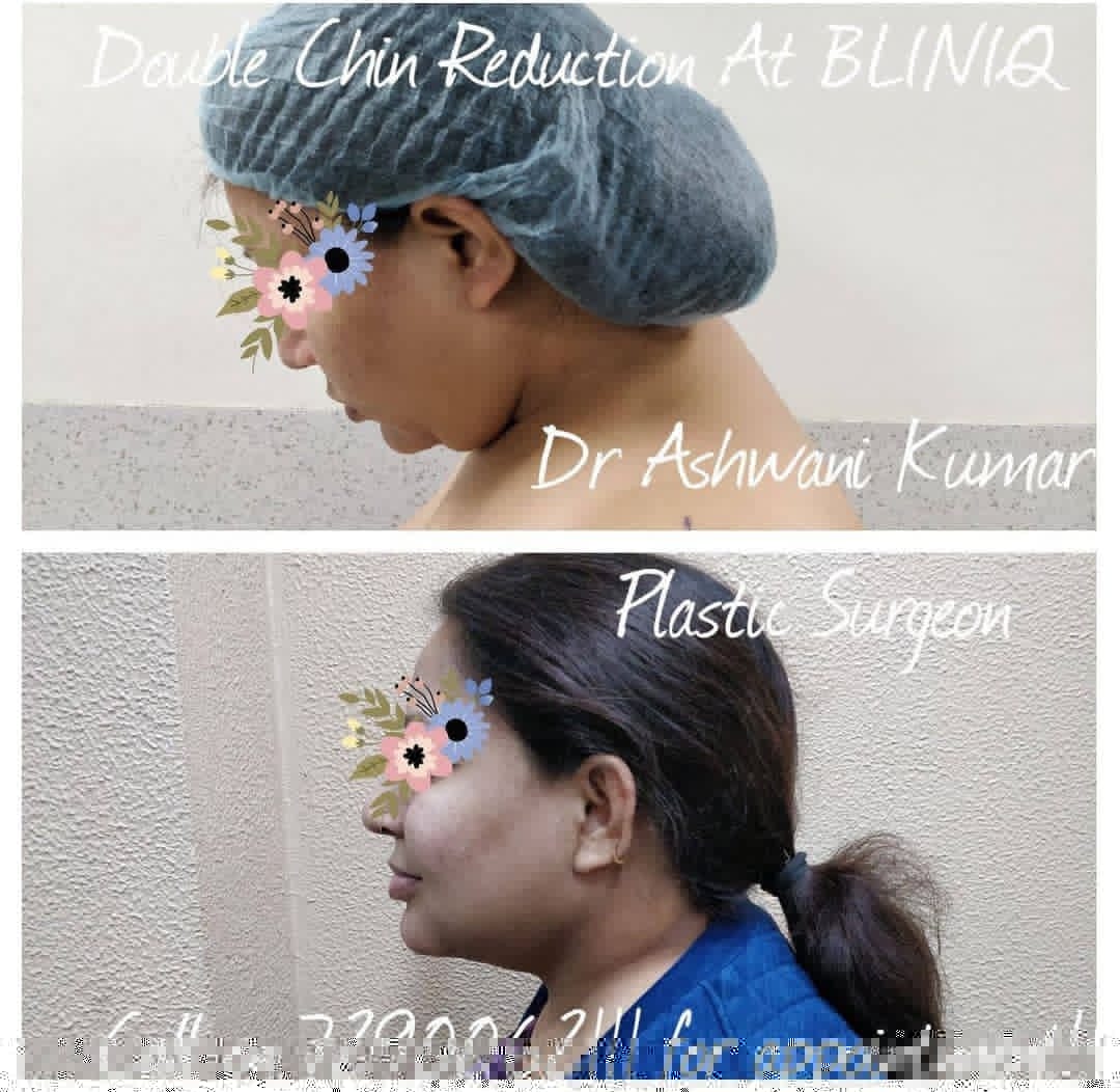 Chin Contouring Before