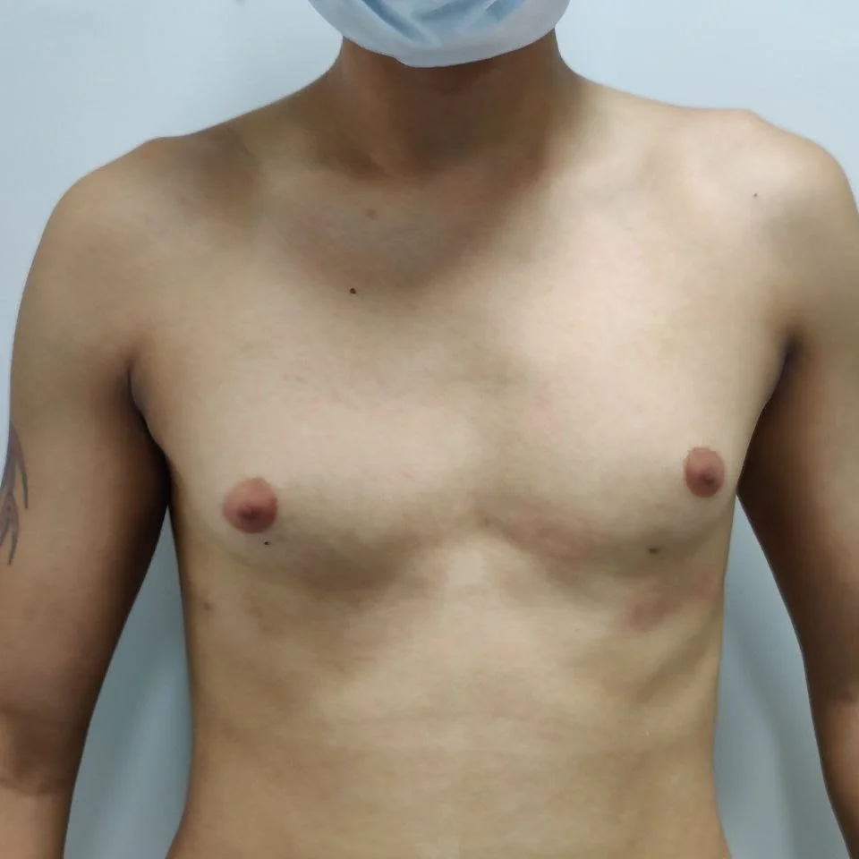 grade 1 for gynecomastia treatment in delhi