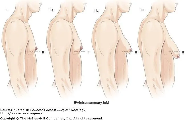 gynecomastia surgery in Delhi