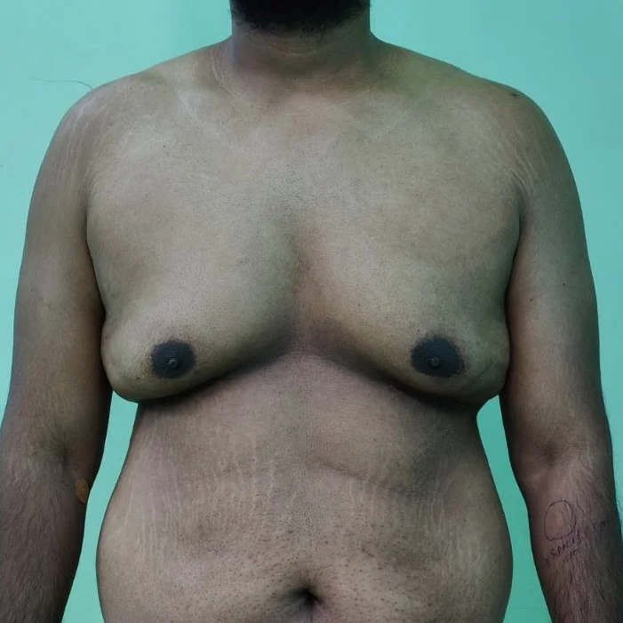 Grade 3 for gynecomastia treatment in delhi