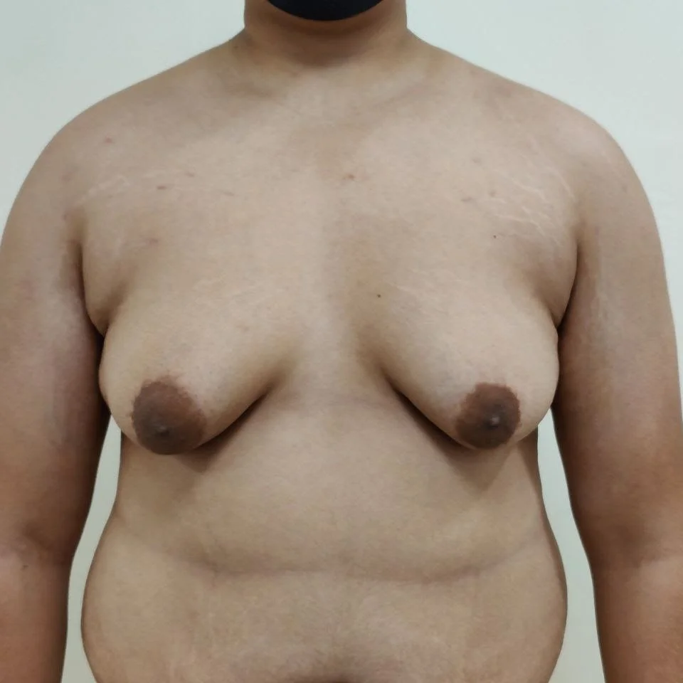 Grade 4 for gynecomastia treatment in delhi