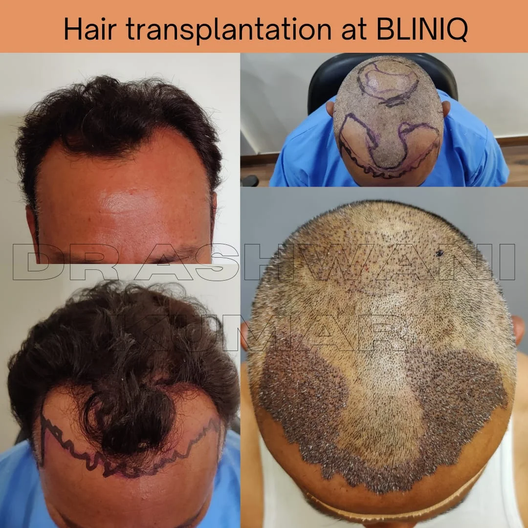 Hair Transplant — Legacy Case 2