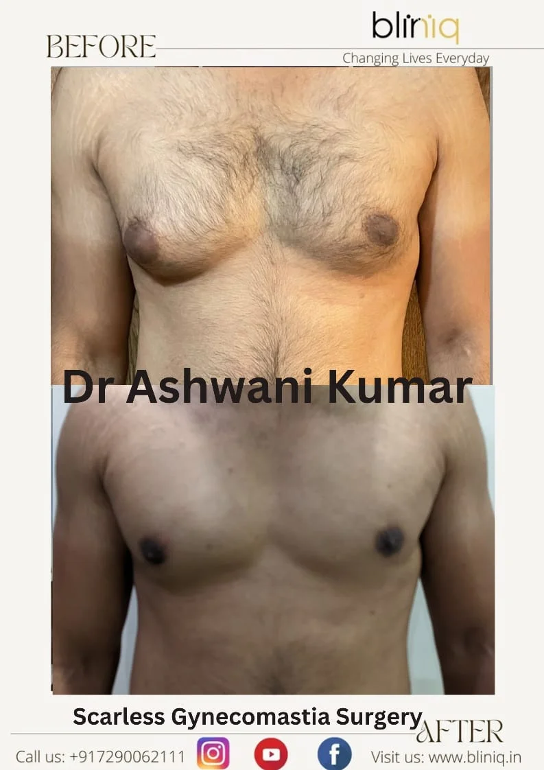 Gynecomastia Correction — Case 8