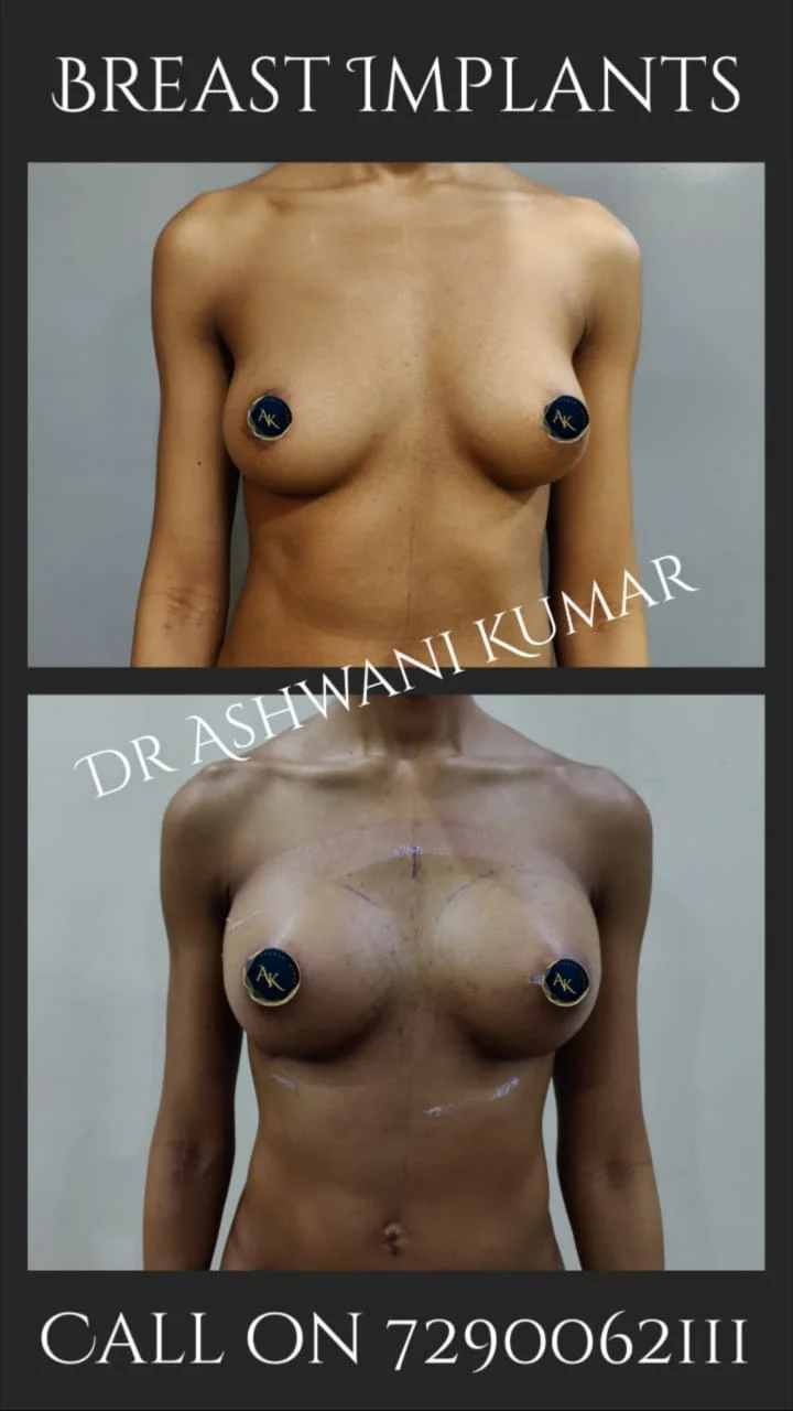 Breast Implants — Legacy Case 1