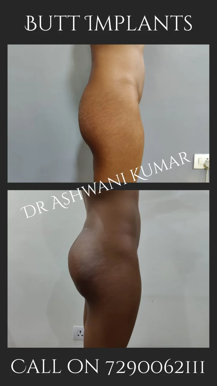 Butt Augmentation — Legacy Case 1