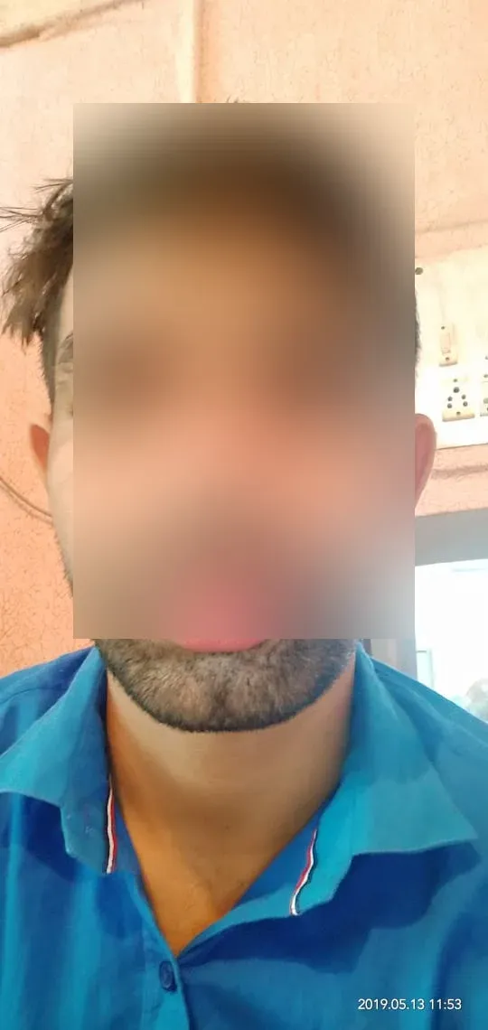 Lip Reduction — Case 1