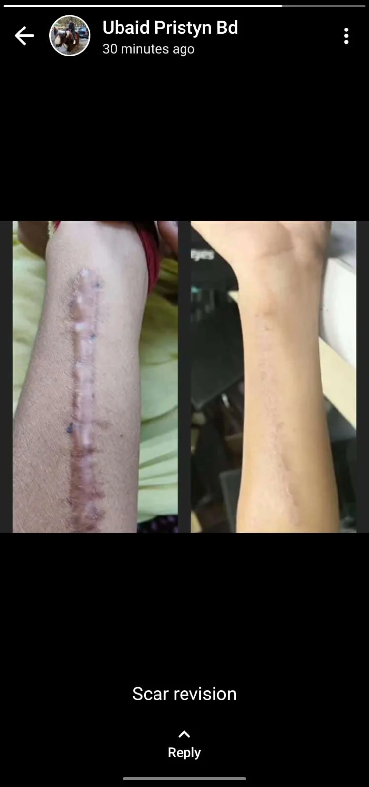 Scar Revision — Case 1