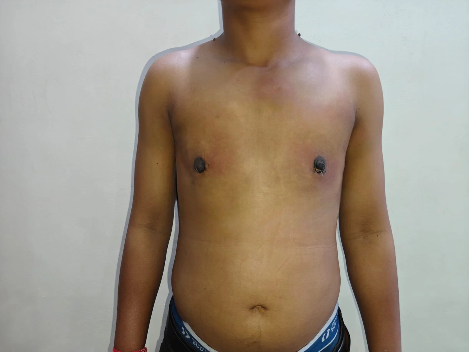 Sex Change (Male to Female) — Case 1