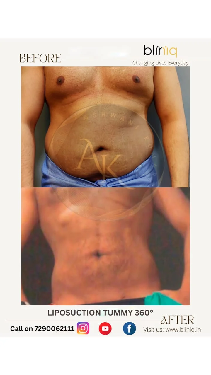 High-Definition 4D Body Contouring — Case 16