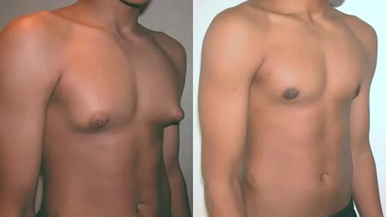 gynecomastia treatment in delhi