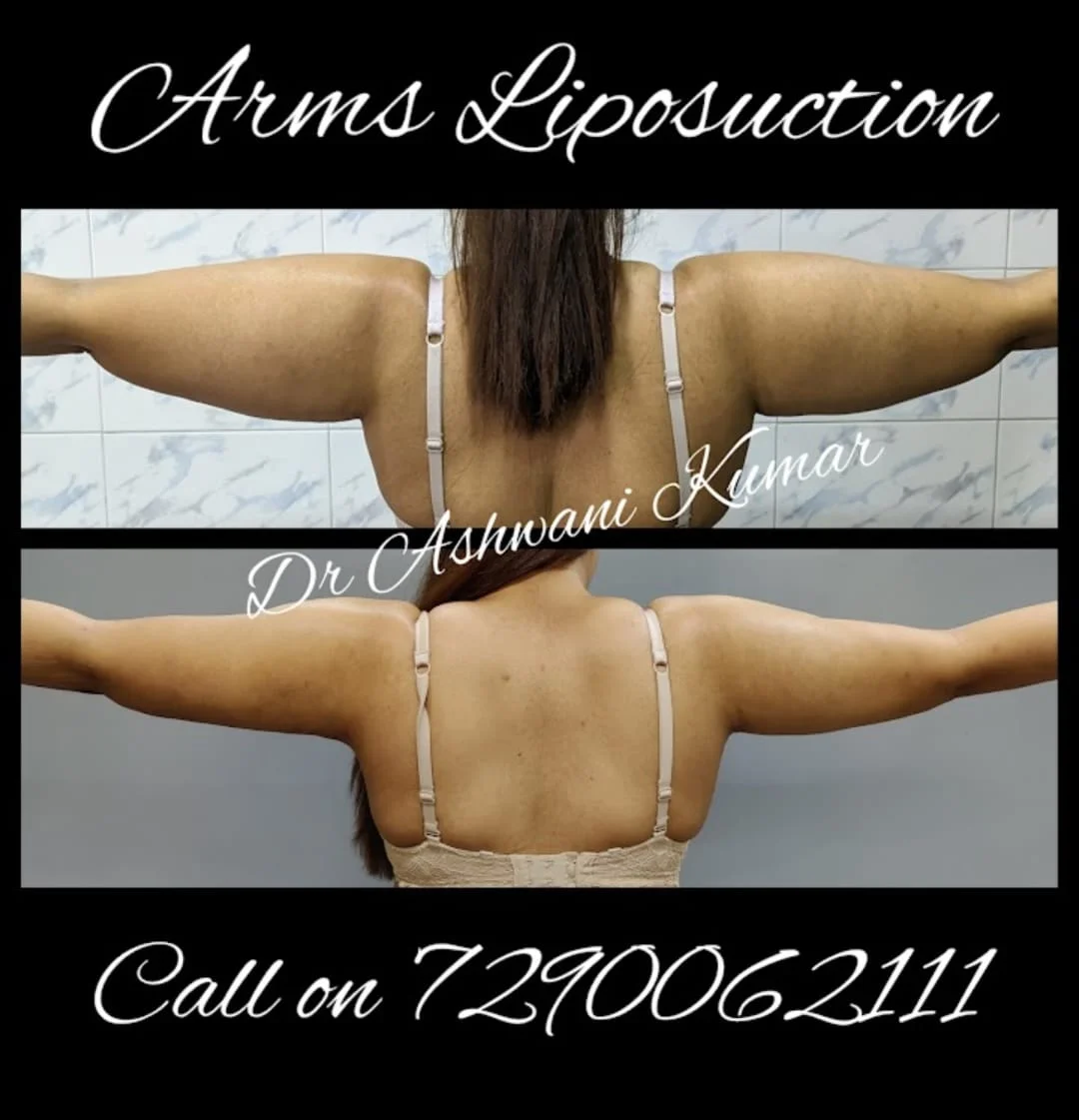 High-Definition 4D Body Contouring — Case 18